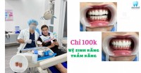 Vệ Sinh Răng – Trám Răng Chỉ Từ 100k Duy Nhất Tại Blue Dental Q.Tân Bình!